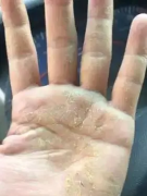 和十几年的湿疹说拜拜